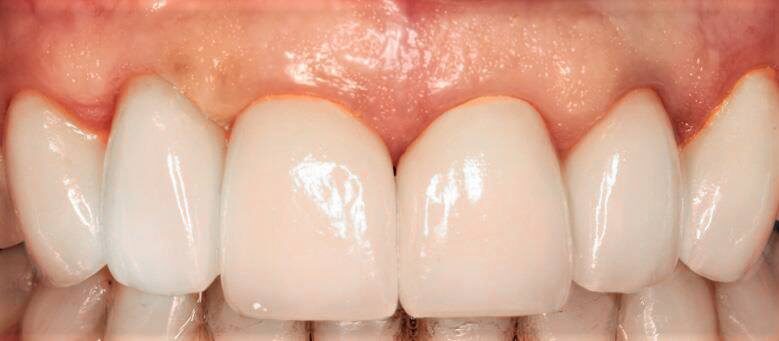 Зъбни Фасети след