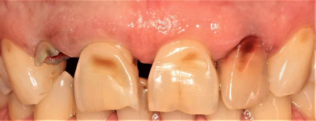 Зъбни фасети