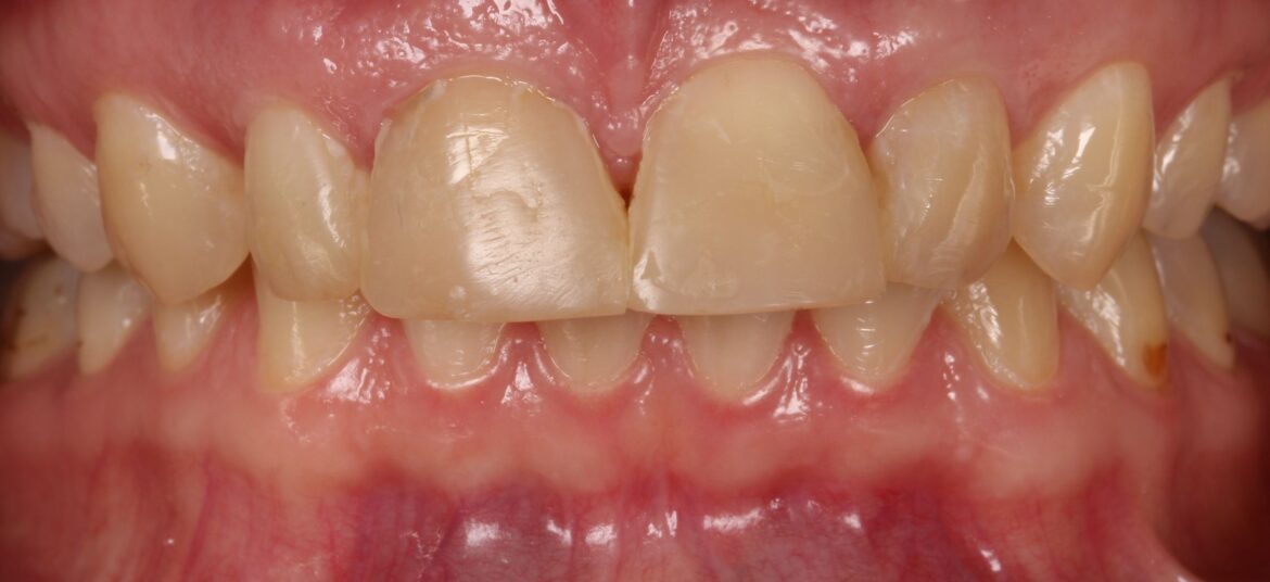 зъбни фасети